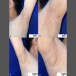 Filipinli kadının koltukaltından süt geldi: Nadir görülen durumun nedeni ne?