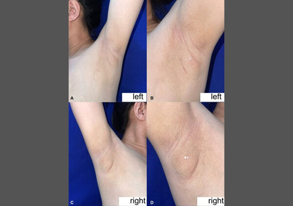 Filipinli kadının koltukaltından süt geldi: Nadir görülen durumun nedeni ne?